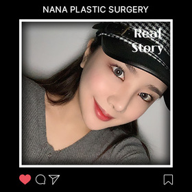 광대, 앞턱, 코, 지방이식 후기