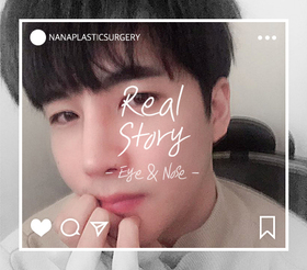 눈성형, 코성형 후기