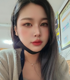 매몰쌍꺼풀, 뒤트임, 밑트임 후기