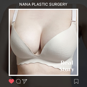 가슴성형, 모티바 후기