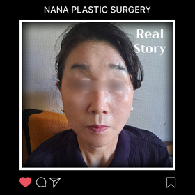 안면거상 후기