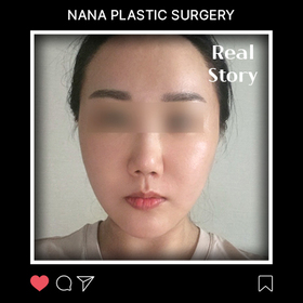 안면거상 후기