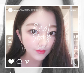 슈링크, 입술필러 후기
