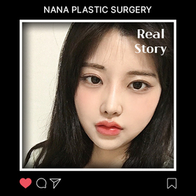 윤곽3종, 코, 절개눈매교정 후기