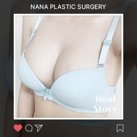 가슴성형, 모티바 후기