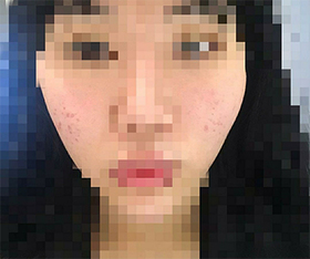 yuyya's Contouring Injection review