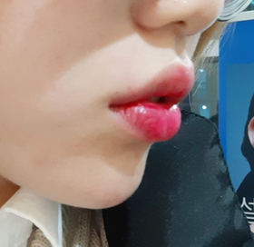 디아루파's Filler, Botox review