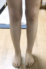 꿀타빈's Calves, Abdominal Liposuction review
