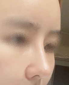 명지스's Nose, Fat Grafting review