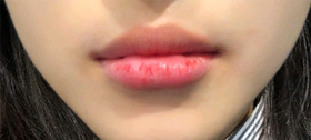 이이ddd's Lip Filler review