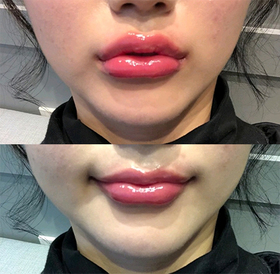 여구나's Lip Filler review