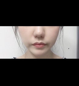 oy1004님의 리프팅,물광주사 후기