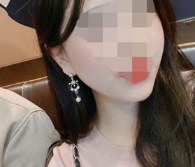 비마스크해's Facial Liposuction review