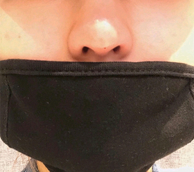 모모99's Nose Sculpting Injection review