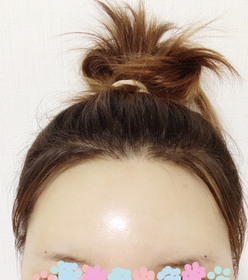 나에요~~'s Forehead Fat Grafting review