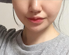 지짖지지지지님의 슈링크,윤곽톡신 후기