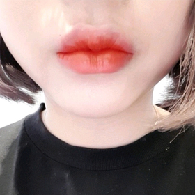 awdrgyj's Lip Filler, Botox review
