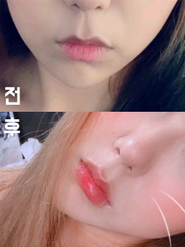 치치케's Lip Filler review