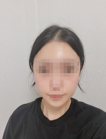 레몬55's Square Jaw Surgery, Chin Reduction review