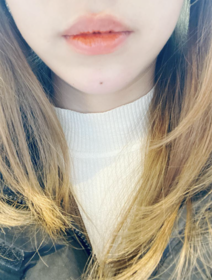 복츙ㅇㅏ뽑호's Chin Filler, Botox review