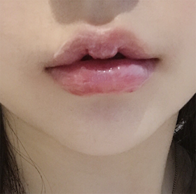 amy13's Lip Filler review