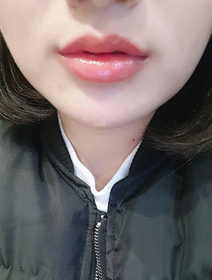 kkd0229's Lip Filler review