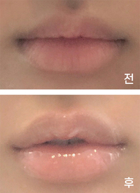 ㅎ링ㅇ's Mouth Corners, Lip Filler review