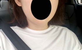 플레인817's Facial Liposuction review