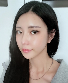 빼빼롱's Non-Incisional Ptosis Correction review