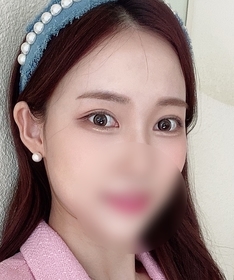 짜냥's Non-Incisional Double Eyelid (Revision) review