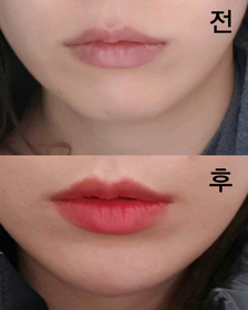 큽's Chin Filler, Botox review