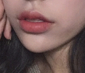 뭐라고할까나's Lip Filler, Botox review