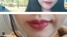 루니99's Lip Filler review