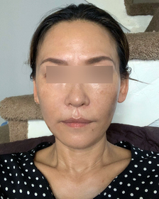 엄마앙투아네트's Facelift review