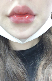 리리걸's Lip Filler review