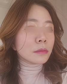 꽃다운나의봄's Facelift review