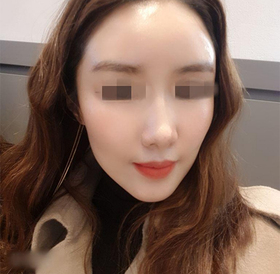 빈빈집's Facial Fat Grafting review