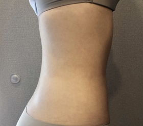 별처럼날아라's Abdomen, Calves, Liposuction review