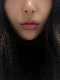 hyb's Lip Filler, Botox review