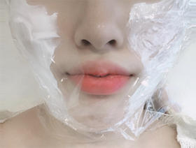 ㅁㅋㅌㅇㅎㅅ님의 슈링크, 윤곽톡스 후기