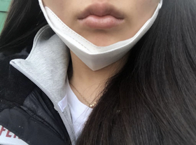 soosooh's Botox, Filler review