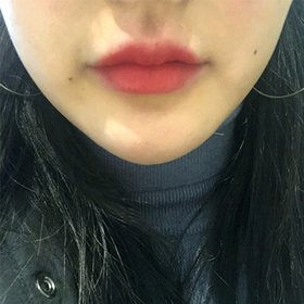 hjhsjs's Jaw Botox, Filler review
