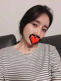 ㅅㄴㄷㄴㅅㅊ's Eyes, Fat Grafting review