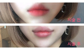 예뻐지잙's Lip Filler review
