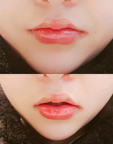 김공주,'s Lip Filler, Botox review