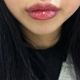 이1쁘듀's Mouth Corner Filler, Botox review