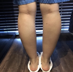쁑귱's Botox, Fat-Dissolving Injection review