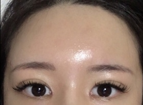 호료룡's Fat Grafting, Eyes review