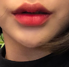 ddd97's Filler, Botox review
