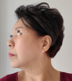 아카시아's Facelift review